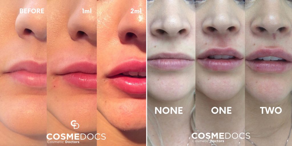 Before, during, and after images showcasing the effects of 2ml lip fillers at various stages.