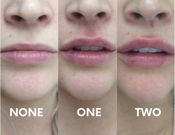 Lip Volume Enhancement: 2ml Fillers Before and After