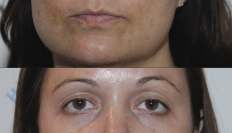 Fantastic before and after treatment for melasma