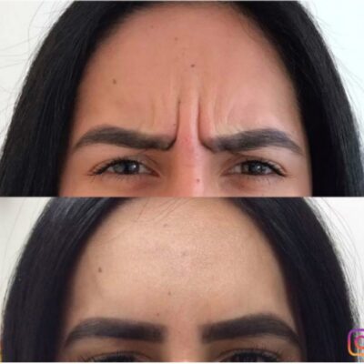 Frown lines before and after Botox treatment, showing a clear smoothing effect.