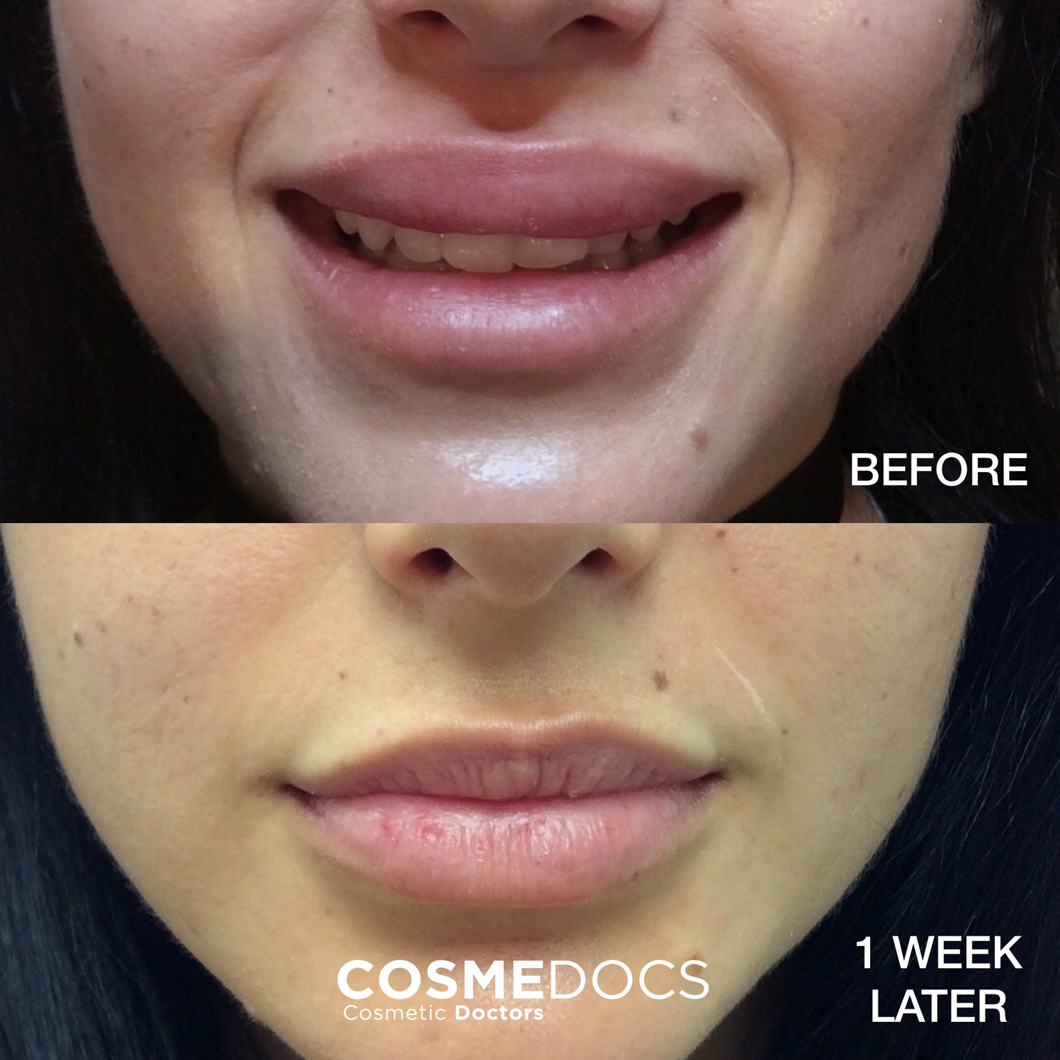 White Spots On Lips After Fillers