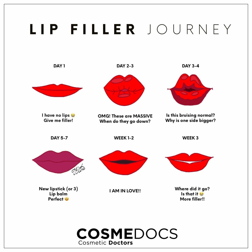 Post Lip Filler Journey To Recovery