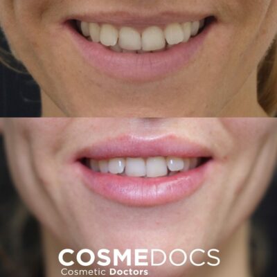 Before and after comparison of a 1ml lip filler treatment aimed at enhancing the smile and reducing the appearance of a gummy smile.
