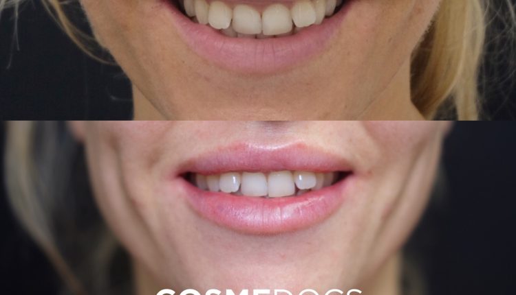 Smile Perfection: 1ml Lip Filler for Gummy Smile Reduction