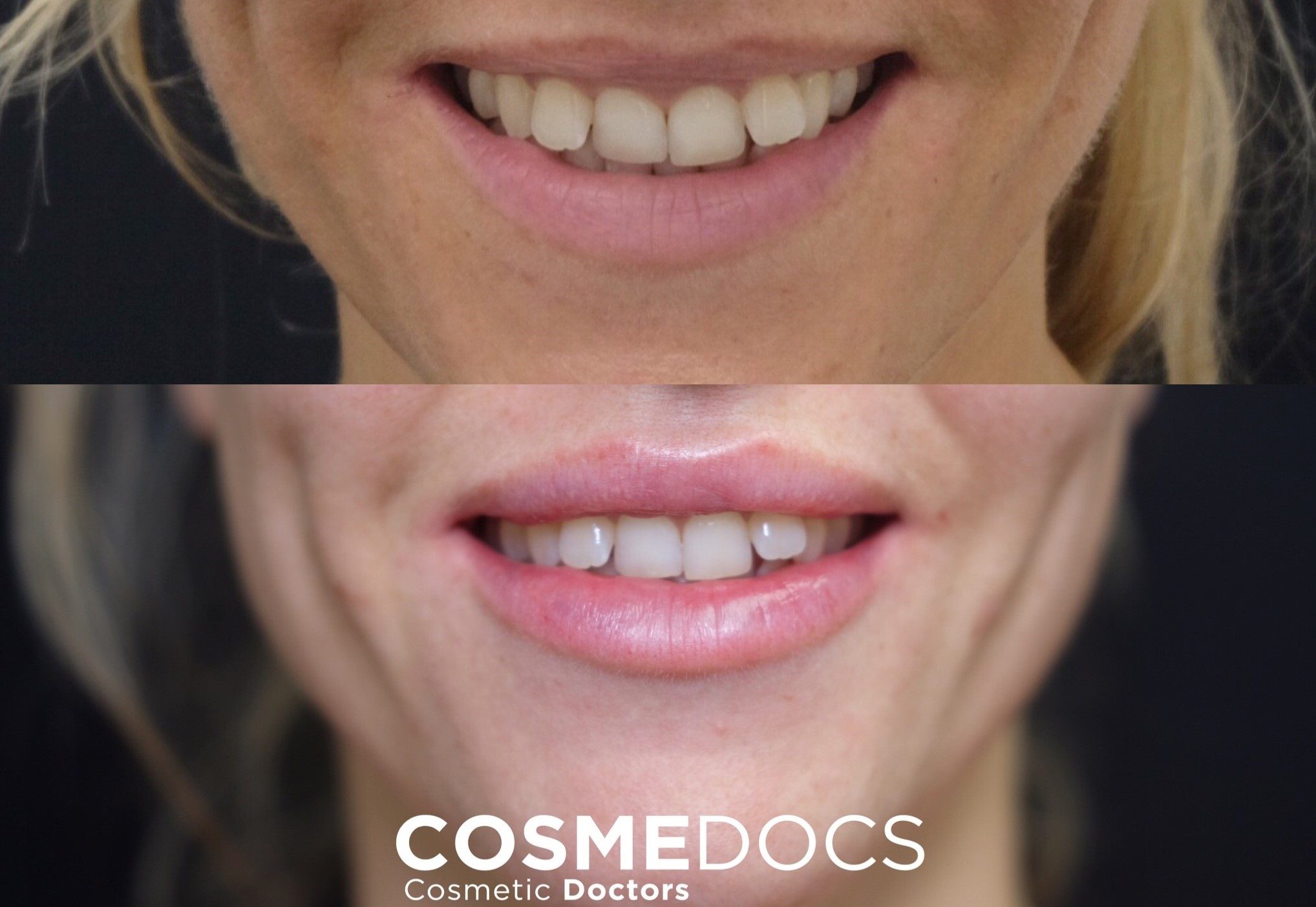 Before and after comparison of a 1ml lip filler treatment aimed at enhancing the smile and reducing the appearance of a gummy smile.