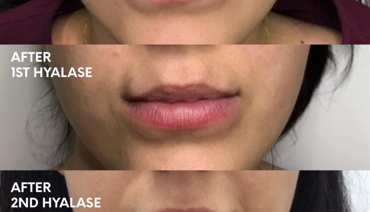 Lip Filler Reversal: Hyalase Enzyme Before and After