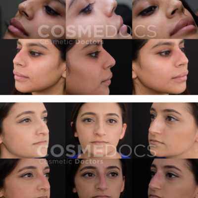 Impressive before and after transformation of a non-surgical nose job using fillers