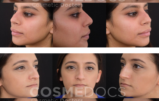 Redefining Aesthetics: Non-Surgical Nose Job Results