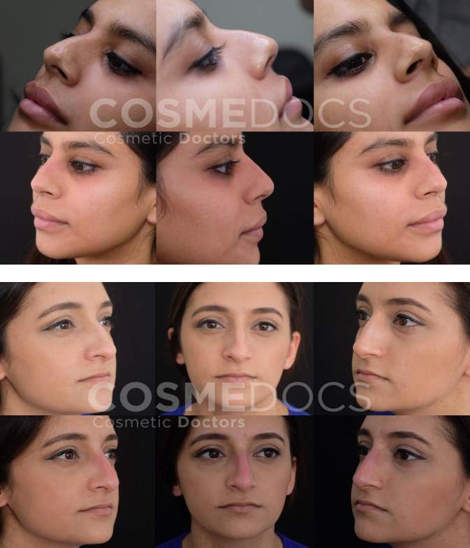 nose fillers before and after