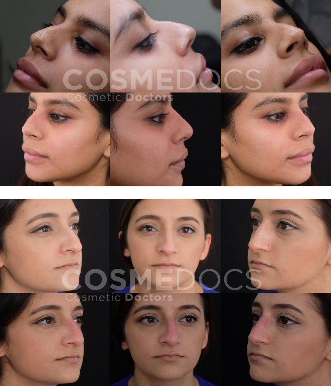 Impressive before and after transformation of a non-surgical nose job using fillers