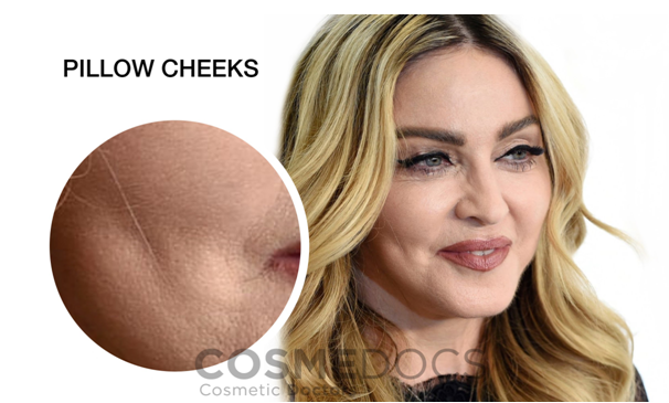 cheek-fillers-gone-wrong