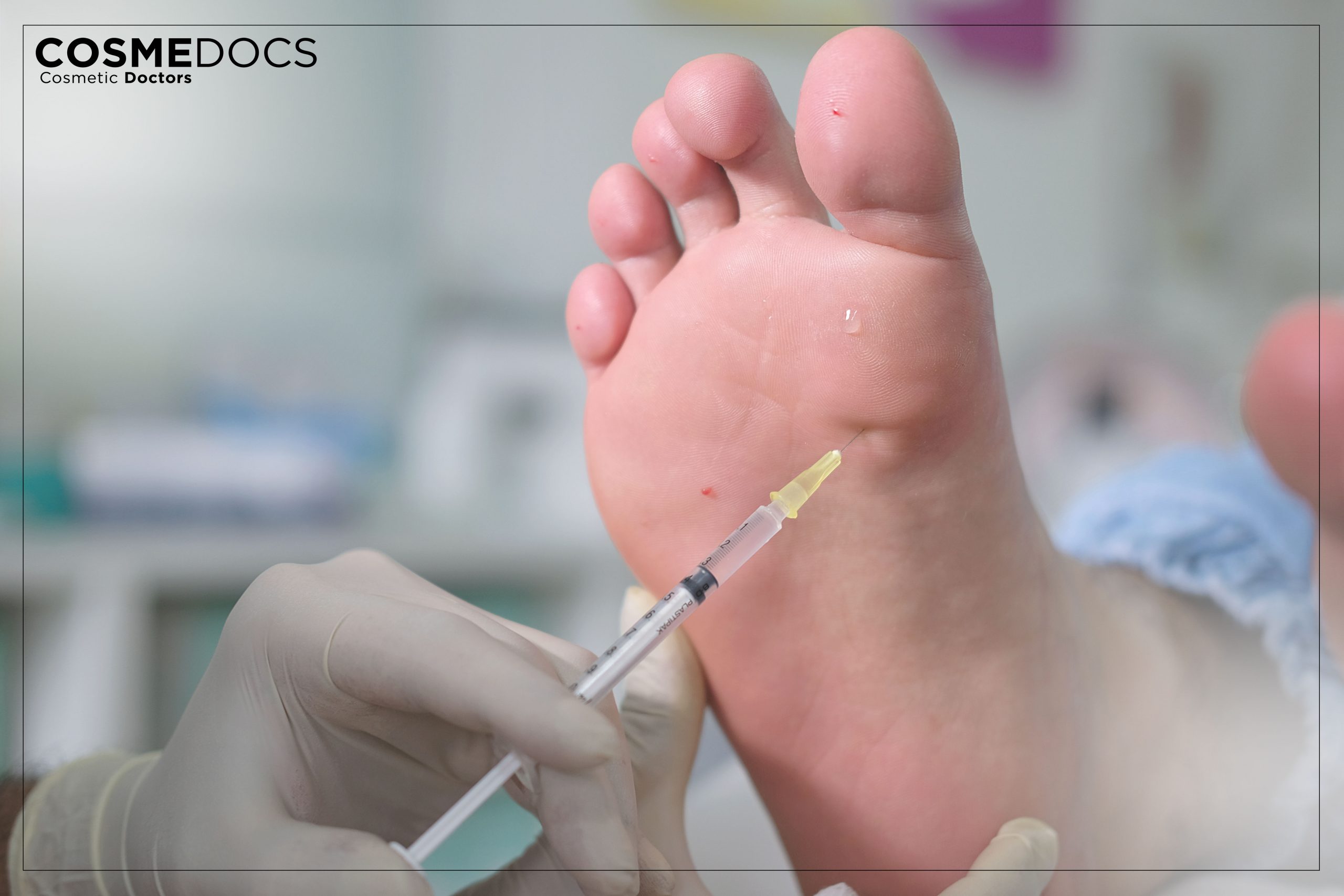 botox excessive sweating treatment for feet