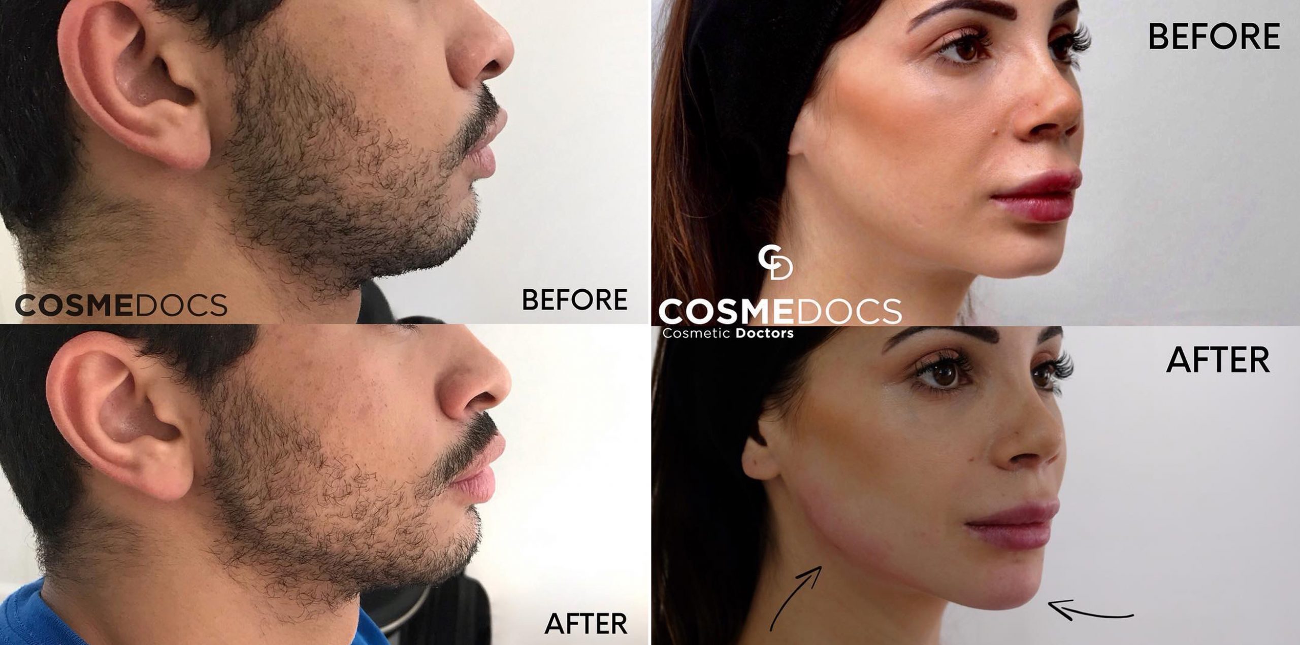 What To Expect In A Jawline Filler Procedure?