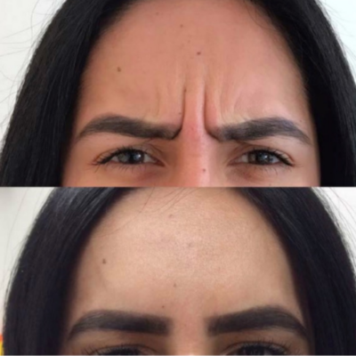 Before and after comparison of frown lines treatment with Botox
