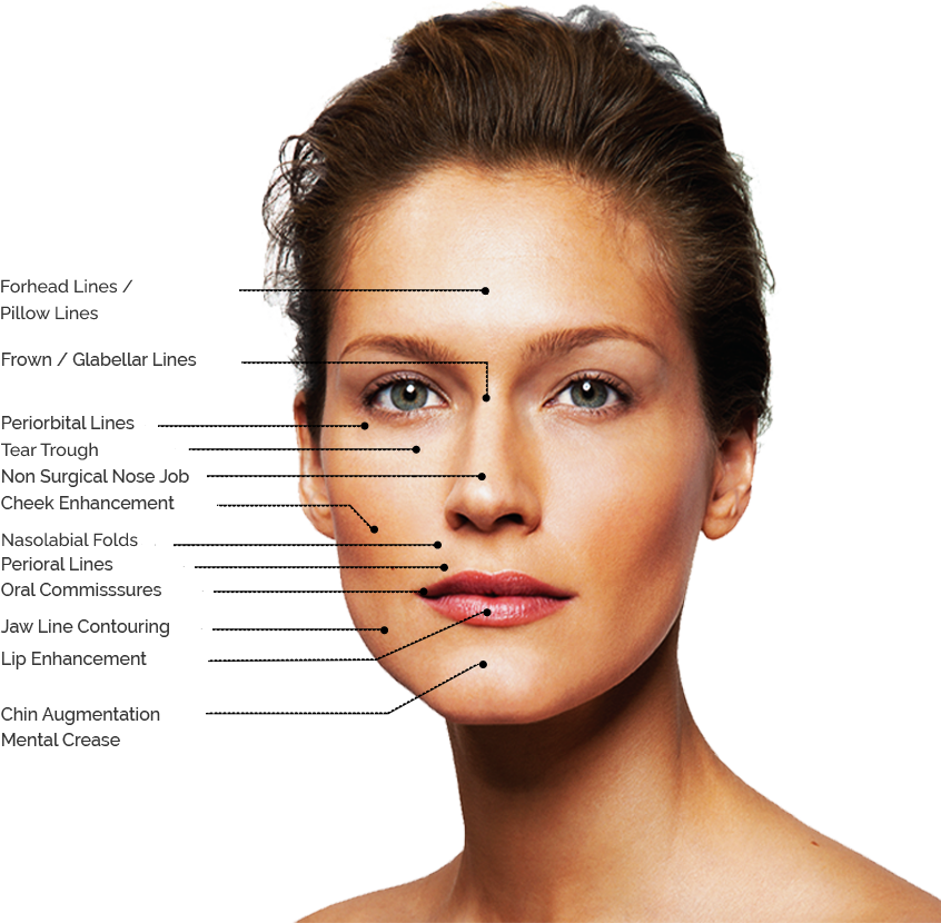areas for face fillers treatment