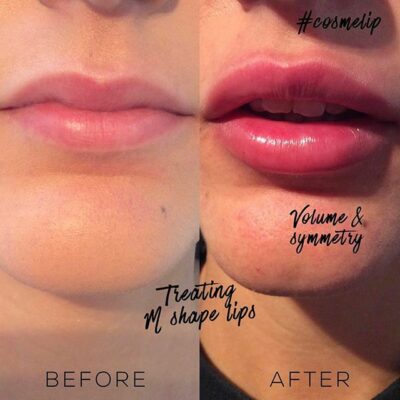Before and after images illustrating a bold lip enhancement achieved with 2ml of filler.
