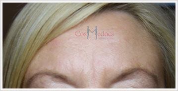 dermal fillers before and after for frown lines