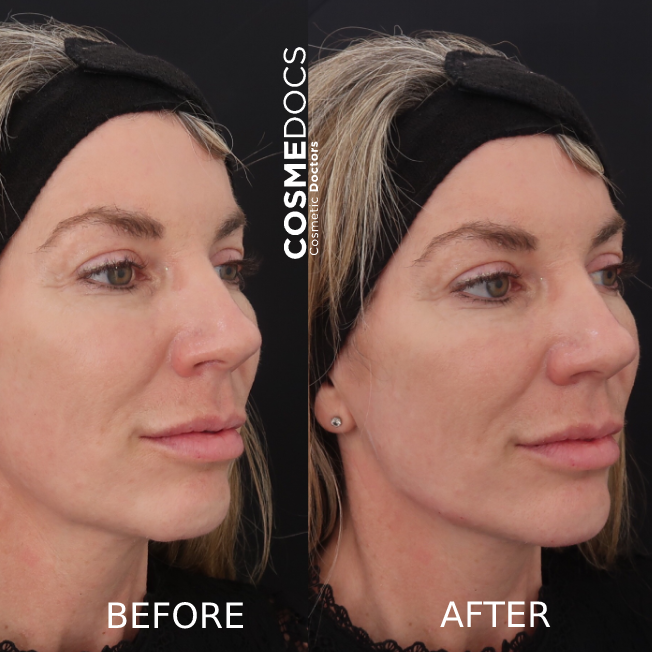 jawline filler before and after