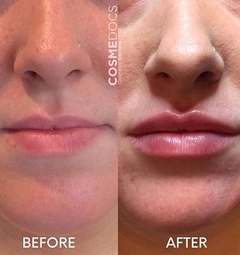 Before and after visuals of lip enhancement using 1ml of lip filler, showcasing a balance of boldness and natural beauty.