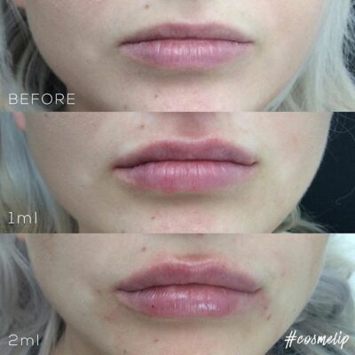 Before and after photos showing lip volume increase from 1ml to 2ml filler on the same individual.