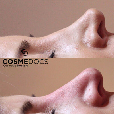 before and after image of a non-surgical nose job to correct a nose bump