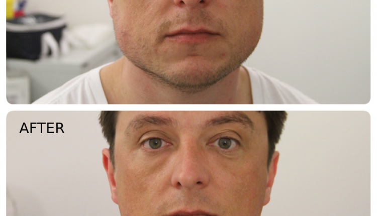 Masseter Botox for Jaw Slimming Treatment in Harley Street, London