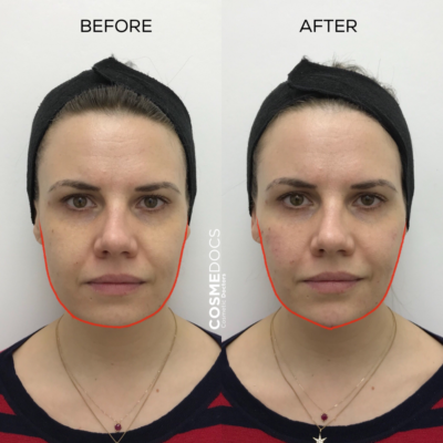 Minor reduction in a wide jaw achieved with a single masseter Botox treatment.