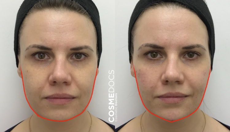 Subtle Jaw Slimming With Masseter Botox: Impact of One Session