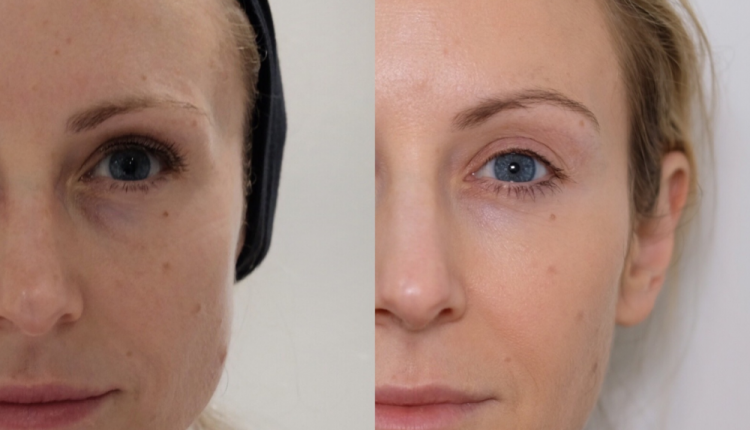 Before and After Masseter Botox on a Large Masseter Muscle: Treatment Results