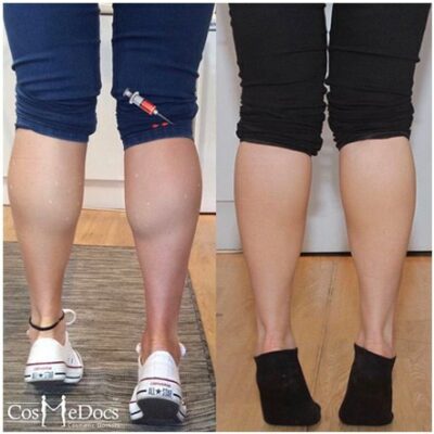 Before and after comparison of Botox calf reduction results.