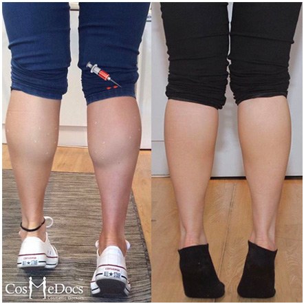 Before and after comparison of Botox calf reduction results.