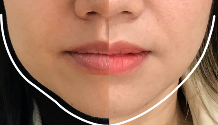 Chin Transformation: Short Chin Correction with Fillers
