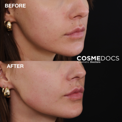Before and after photos showcasing the enhancement of the lower facial profile with jawline and chin fillers.