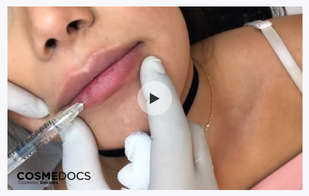 Lip Filler Tretment Video