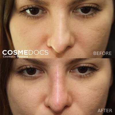Restoration of nose contour and correction of indentations with filler.