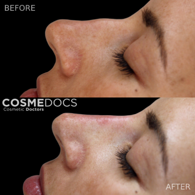 before and after of a non-surgical nose job correcting a minor nasal bump