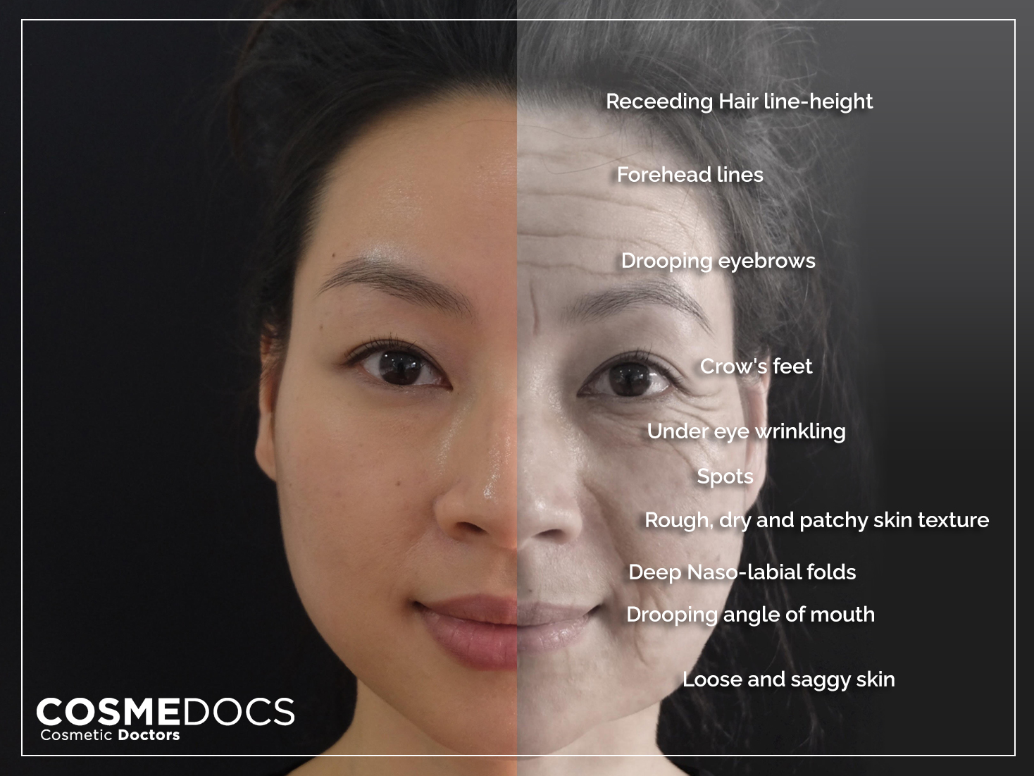 get rid of fine lines on forehead