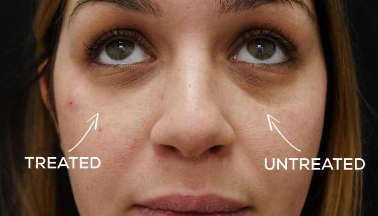 Eye Area Transformation: Correcting Tear Troughs and Dark Circles