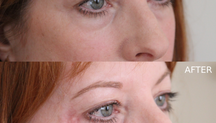 Under-Eye Rejuvenation: Tear-Trough Filler Transformation
