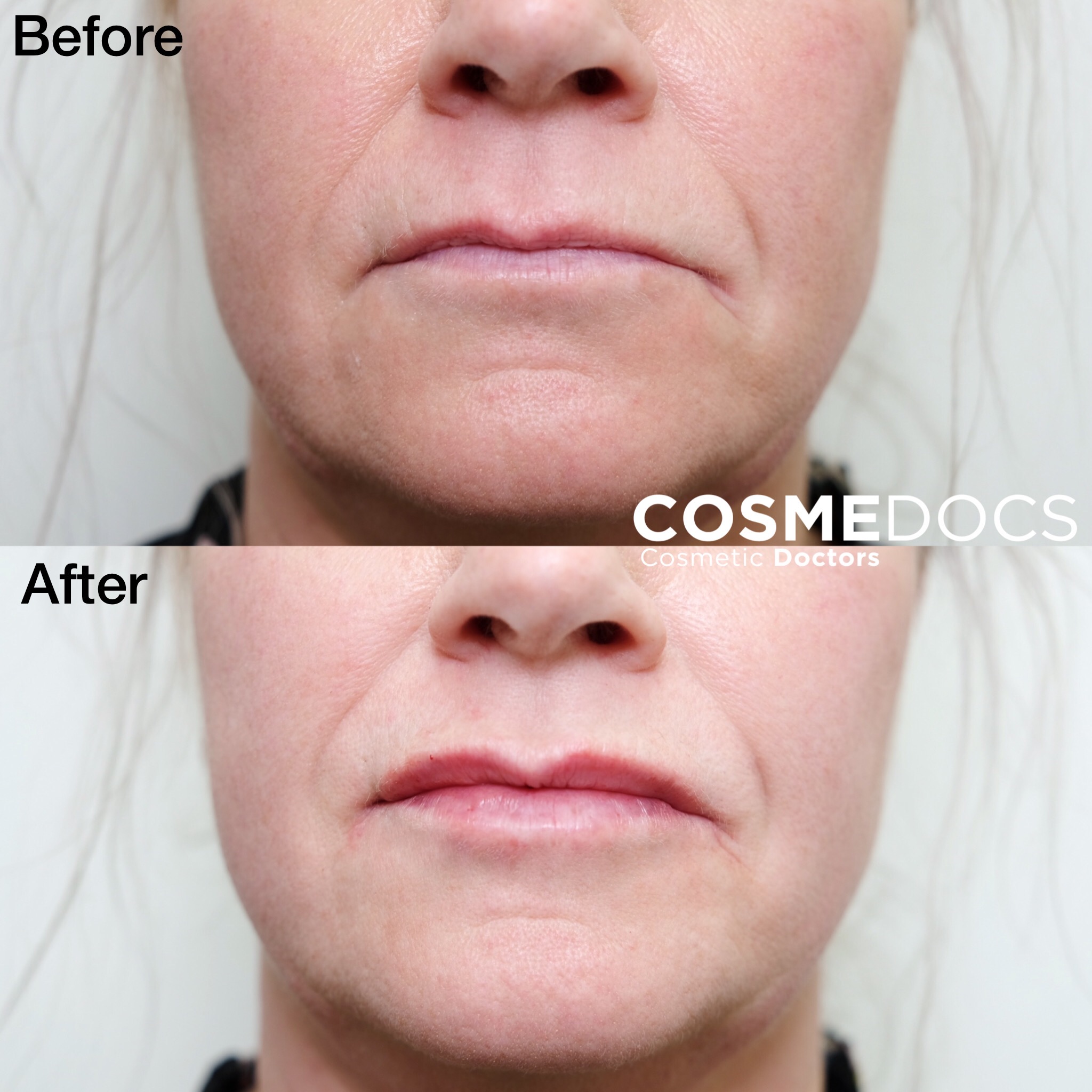 https://www.cosmedocs.com/wp-content/uploads/2021/07/lip-correction-before-and-after-1.jpg