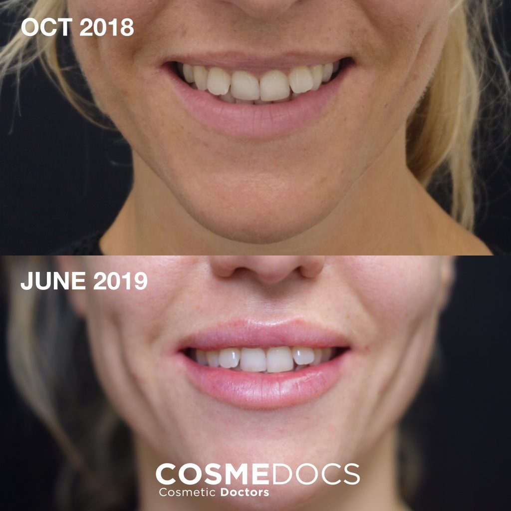 Lip Flip Before And After Picture Showing Improved Upper Lip Volume and Gummy Smile Reduction