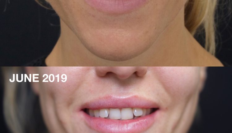 Lip Flip Botox treatment