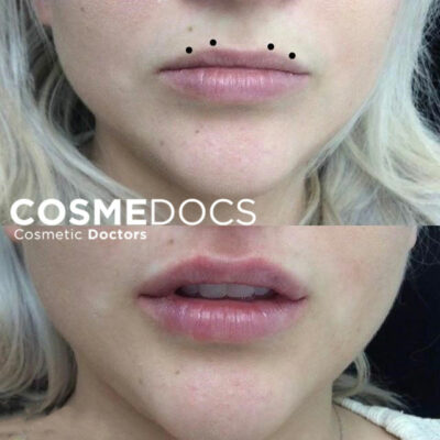 Minimalist Botox Lip Flip for a Subtle, Natural Lip Enhancement Before and After
