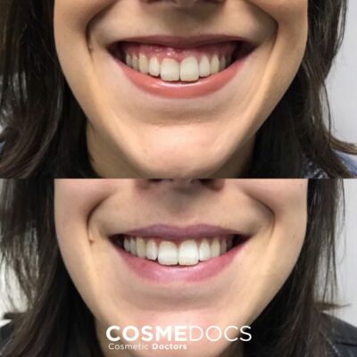 Before and after treatment for a gummy smile with Botox.