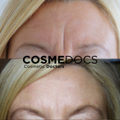 Frown lines smoothed by Botox, visible in before and after photos.