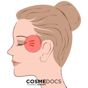 eye-wrinkles-cosmedocs