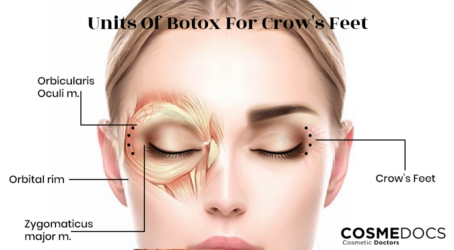 crows-feet-botox-injection-site