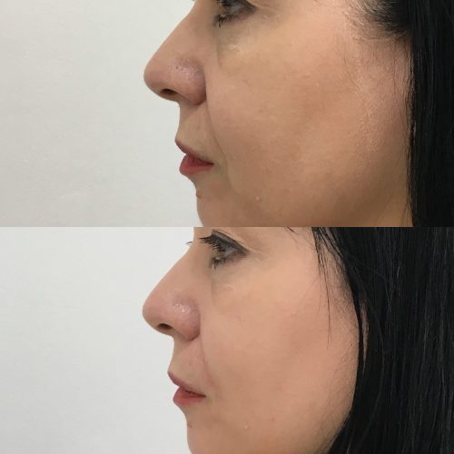 Hydrafacial before and after treatment picture