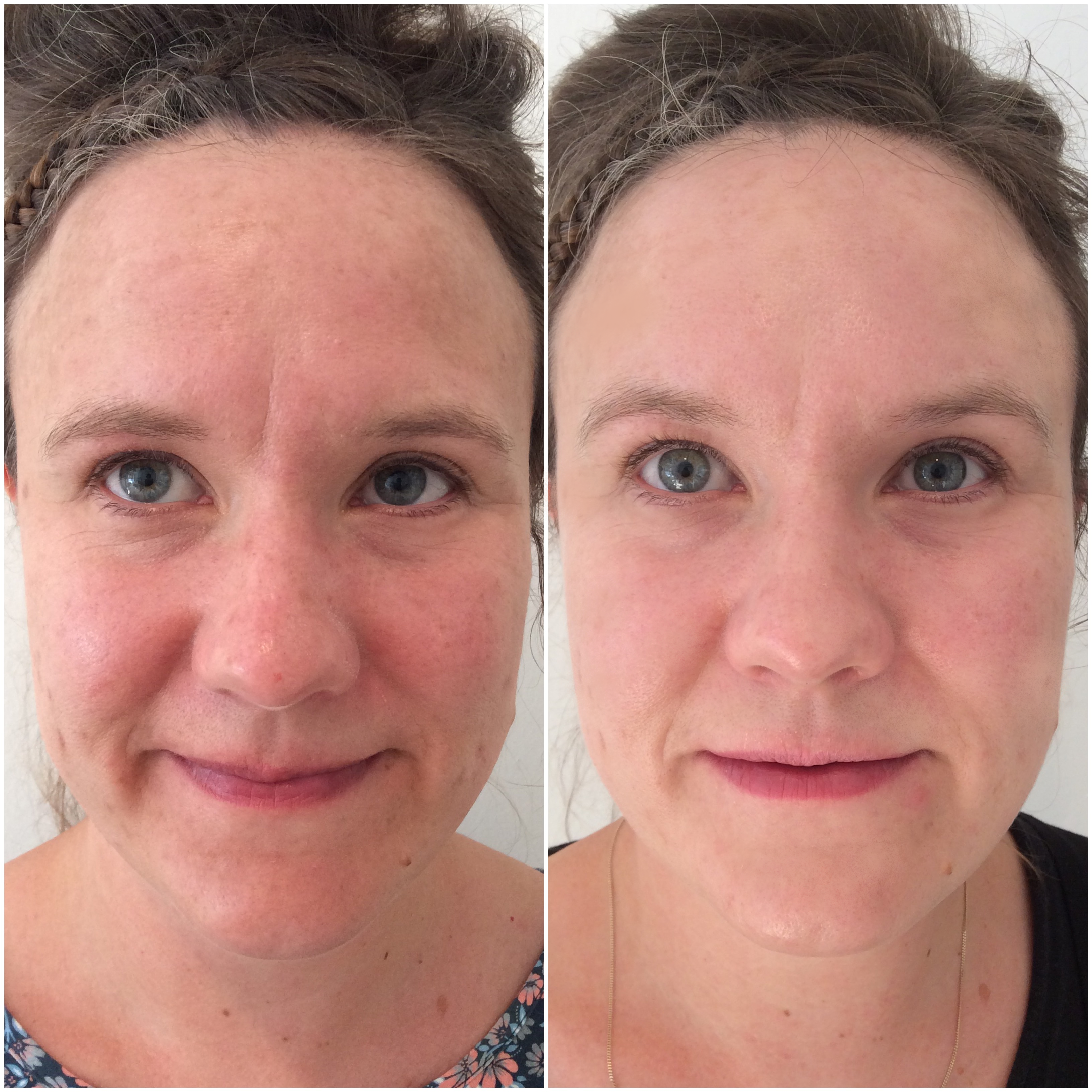 sun damage treatment peel to reveal before and after