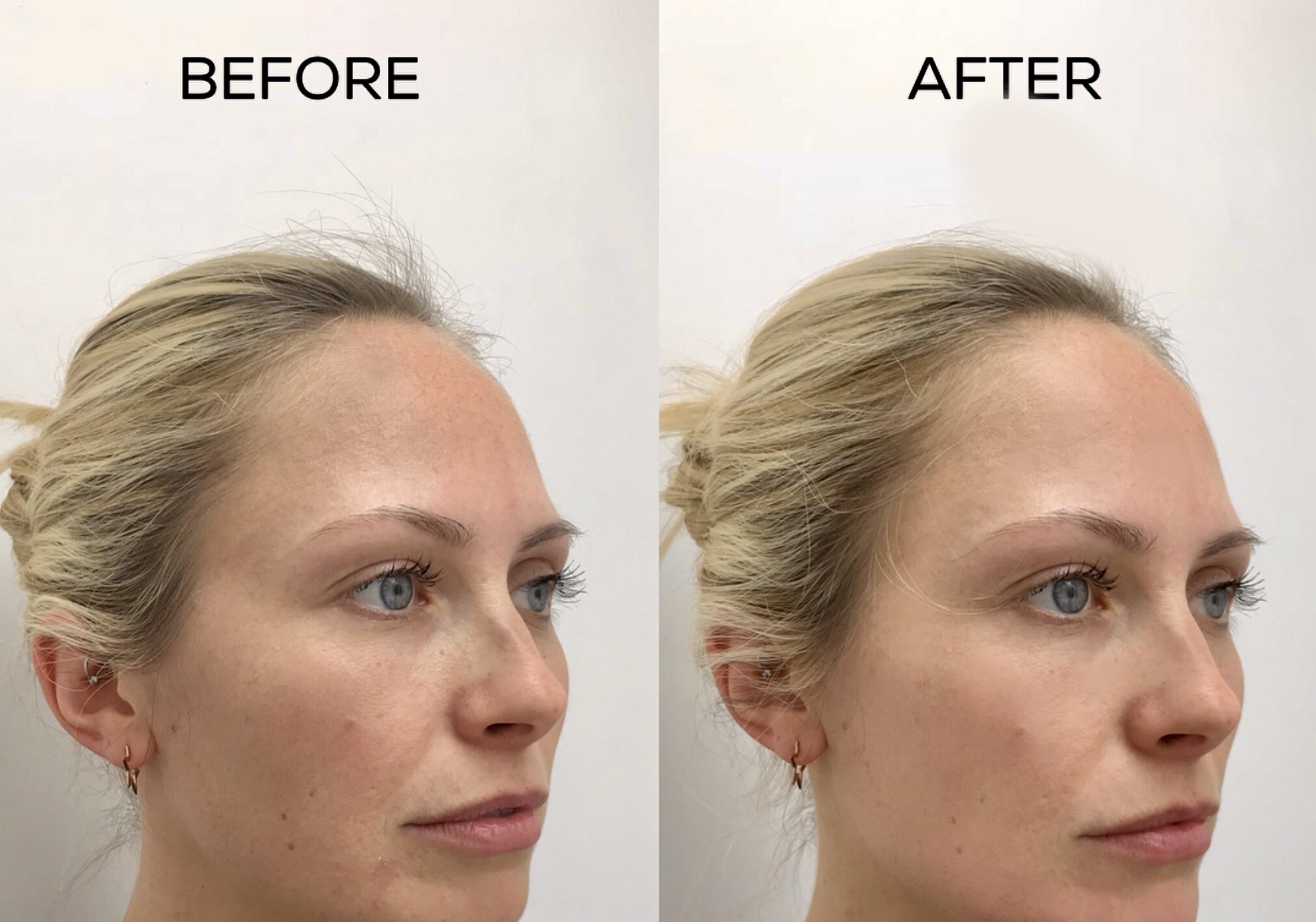 sun damaged treatment befor and after
